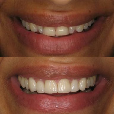 Before and After